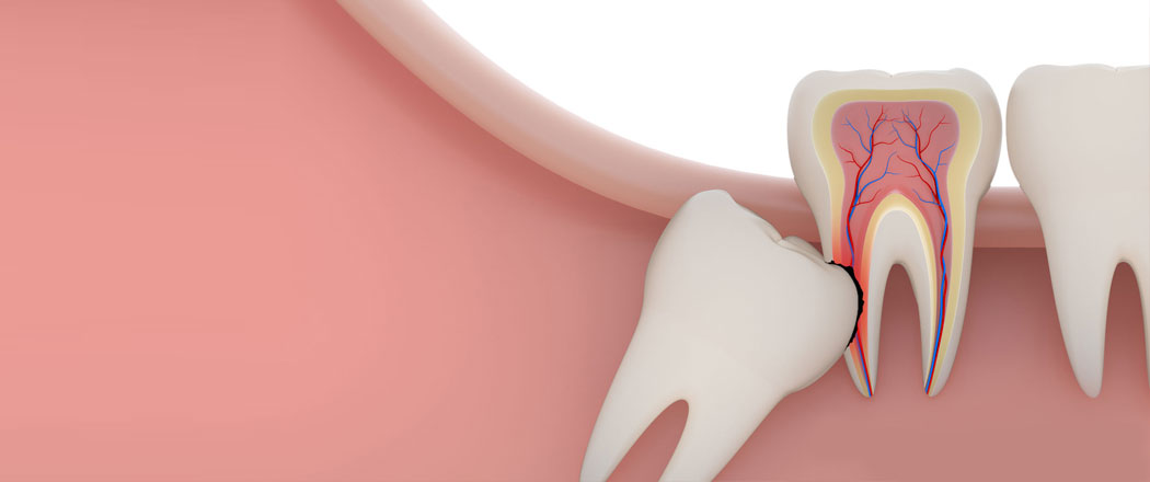 implant-post-1 Root Canal Treatments in Taunton, MA