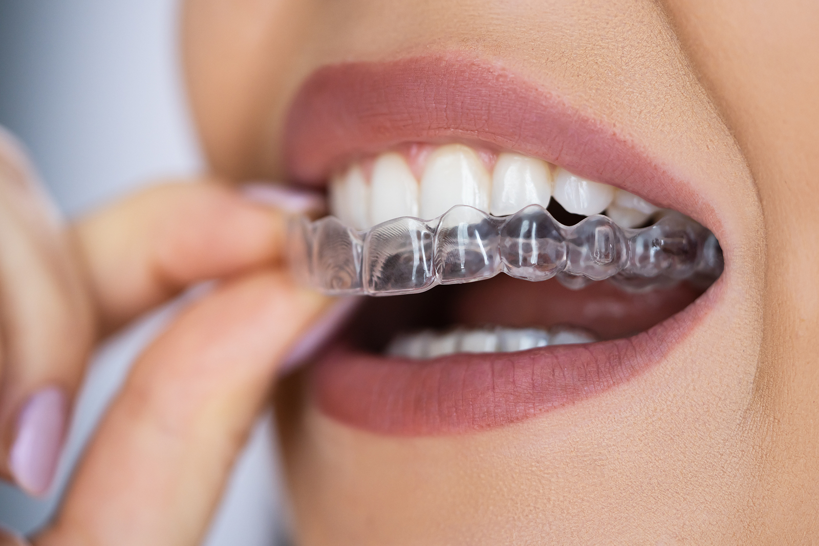 implant-post-1 Root Canal Treatments in Taunton, MA