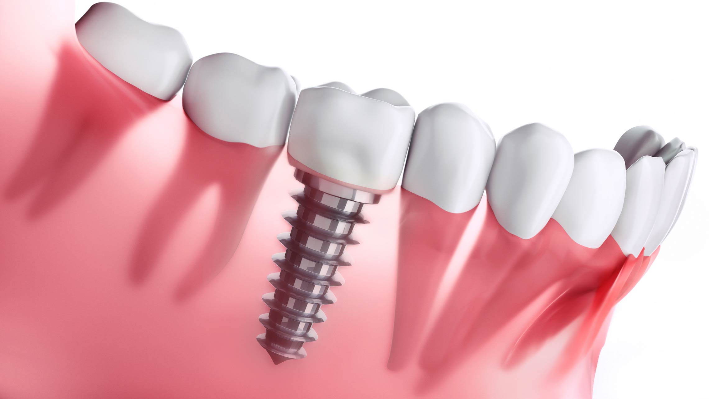 implant-post-1 Root Canal Treatments in Taunton, MA