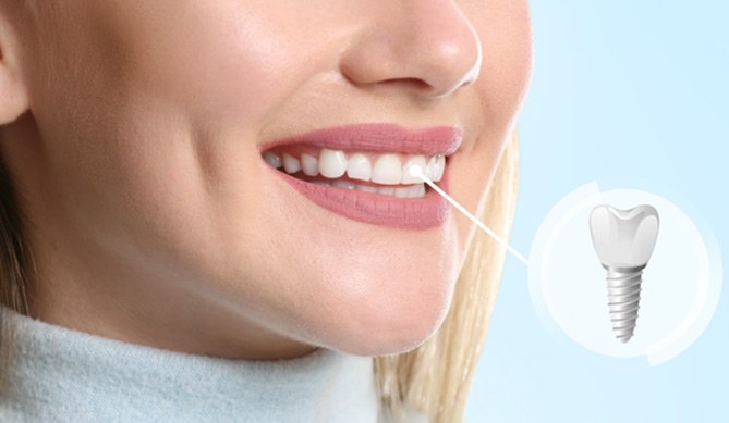 implant-post-1 Root Canal Treatments in Taunton, MA