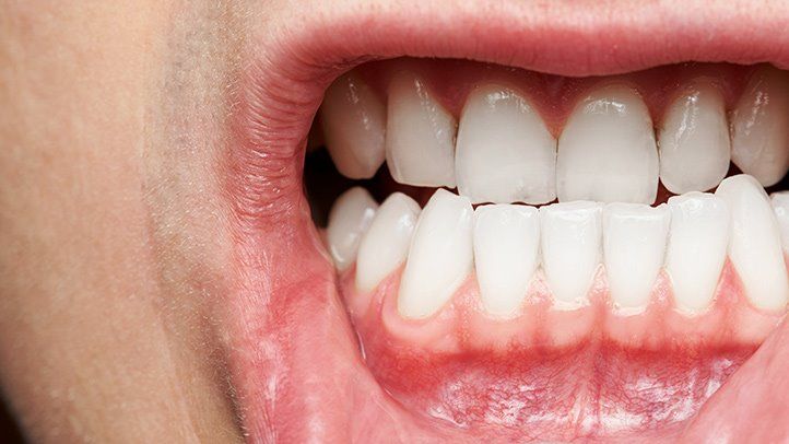implant-post-1 Root Canal Treatments in Taunton, MA