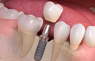 Conventional Implants Conventional Implants