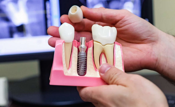 IMPLANTS IN 72 hours IMPLANTS IN 72 hours